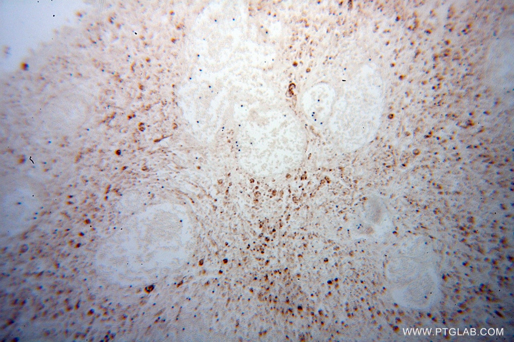 Immunohistochemistry (IHC) staining of human osteosarcoma tissue using VDAC3 Polyclonal antibody (14451-1-AP)