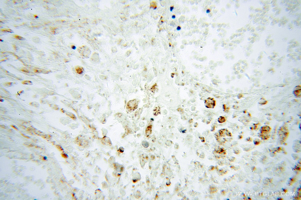 Immunohistochemistry (IHC) staining of human osteosarcoma tissue using VDAC3 Polyclonal antibody (14451-1-AP)