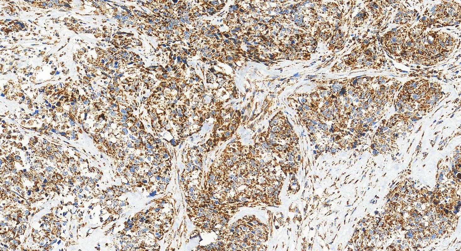 Immunohistochemical analysis of paraffin-embedded human ovary cancer tissue slide using RMX00001 (VDAC3 antibody) at dilution of 1:1000 (under 20x lens). Heat mediated antigen retrieval with Tris-EDTA buffer (pH 9.0). Immunohistochemistry (IHC) staining of human ovary cancer tissue using Multi-rAb® VDAC3 Multi-Recombinant antibody (RMX00001)