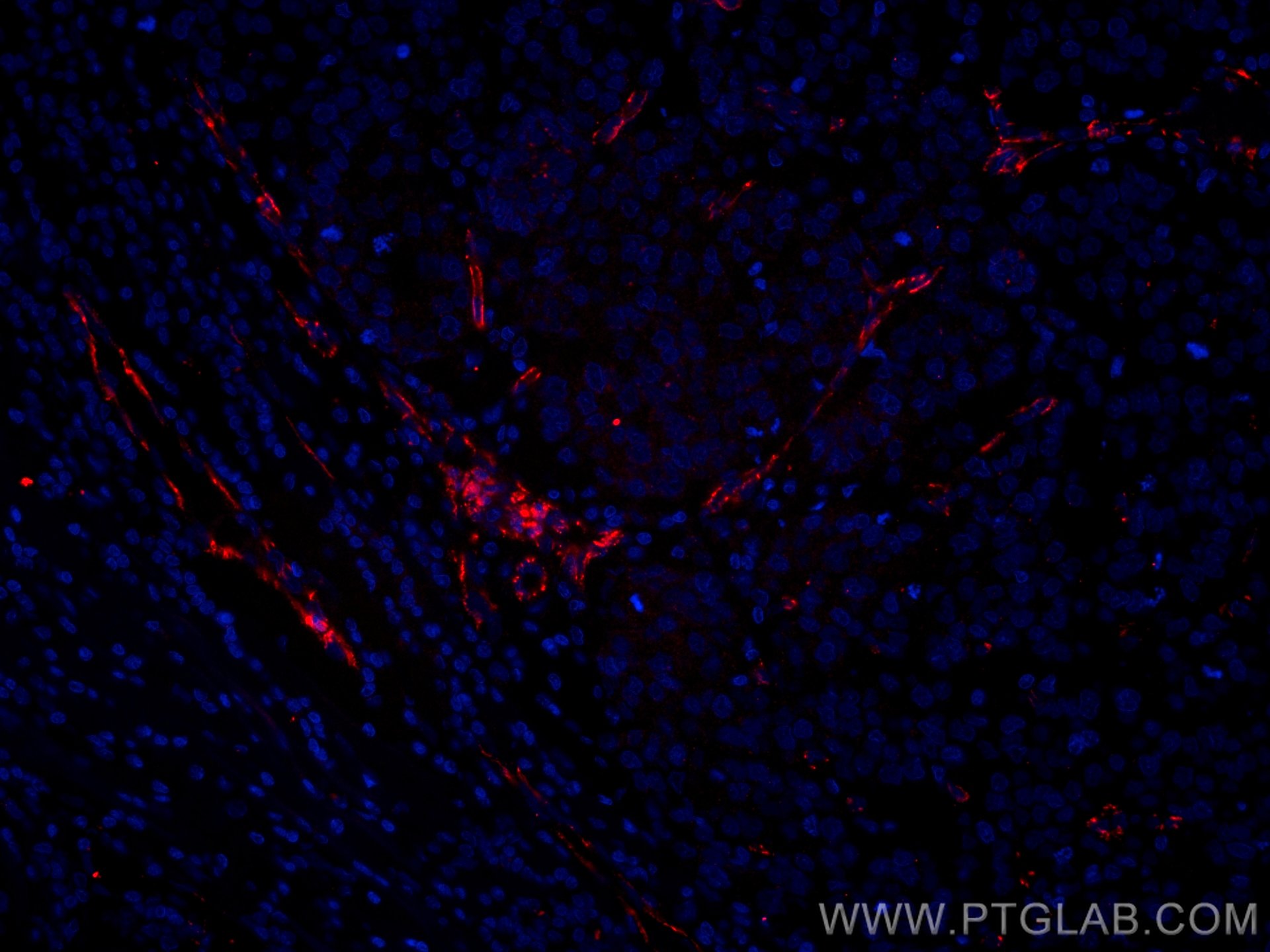 Immunofluorescence (IF) / fluorescent staining of human breast cancer tissue using CoraLite®594-conjugated VE-cadherin Monoclonal ant (CL594-66804)