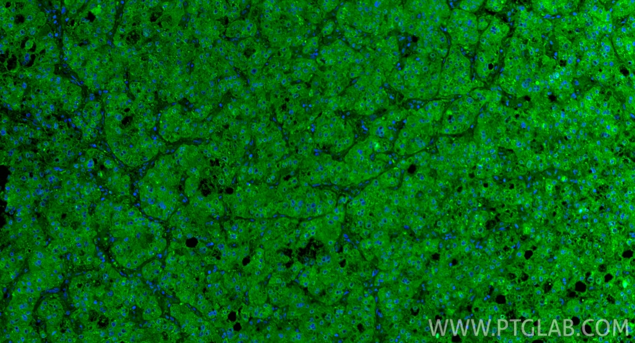 Immunofluorescent analysis of (4% PFA) fixed paraffin-embedded human liver cancer tissue using VEGFA antibody (19003-1-AP) at dilution of 1:200 and CoraLite®488-Conjugated Goat Anti-Rabbit IgG(H+L) (SA00013-2). Heat mediated antigen retrieval with Tris-EDTA buffer (pH 9.0). Immunofluorescence (IF) / fluorescent staining of human liver cancer tissue using VEGFA Polyclonal antibody (19003-1-AP)