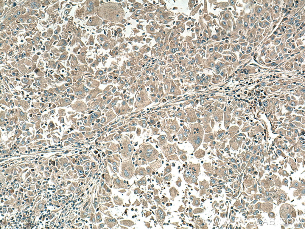 Immunohistochemistry (IHC) staining of human liver cancer tissue using VEGFA Polyclonal antibody (19003-1-AP)