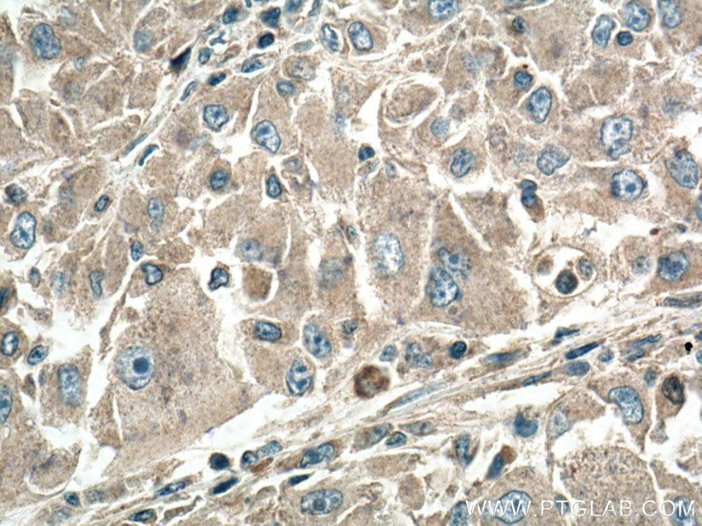 Immunohistochemistry (IHC) staining of human liver cancer tissue using VEGFA Polyclonal antibody (19003-1-AP)