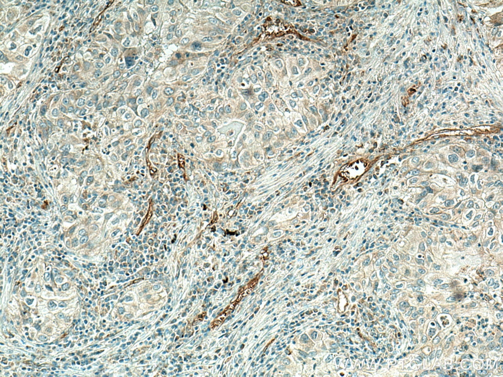 Immunohistochemistry (IHC) staining of human lung cancer tissue using VEGFA Polyclonal antibody (19003-1-AP)