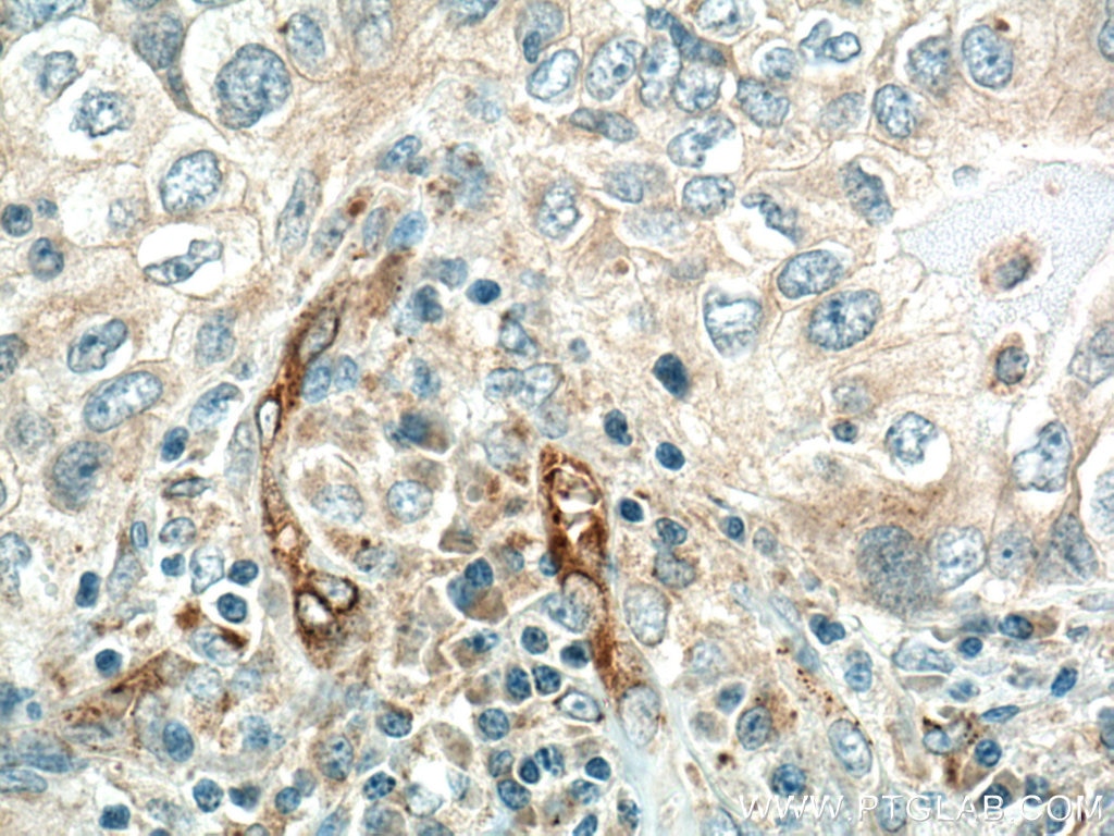 Immunohistochemistry (IHC) staining of human lung cancer tissue using VEGFA Polyclonal antibody (19003-1-AP)