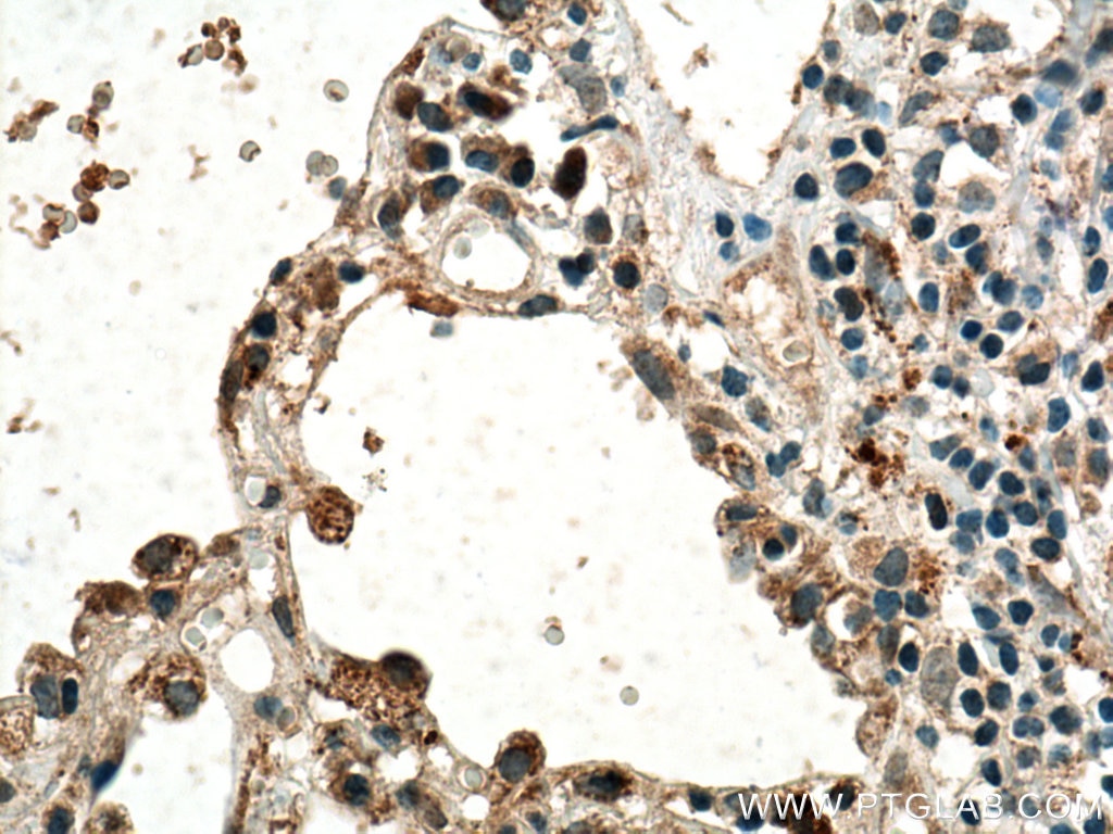 IHC staining of human lung cancer using 19003-1-AP
