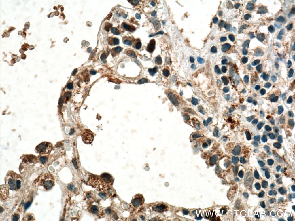 Immunohistochemistry (IHC) staining of human lung cancer tissue using VEGFA Polyclonal antibody (19003-1-AP)