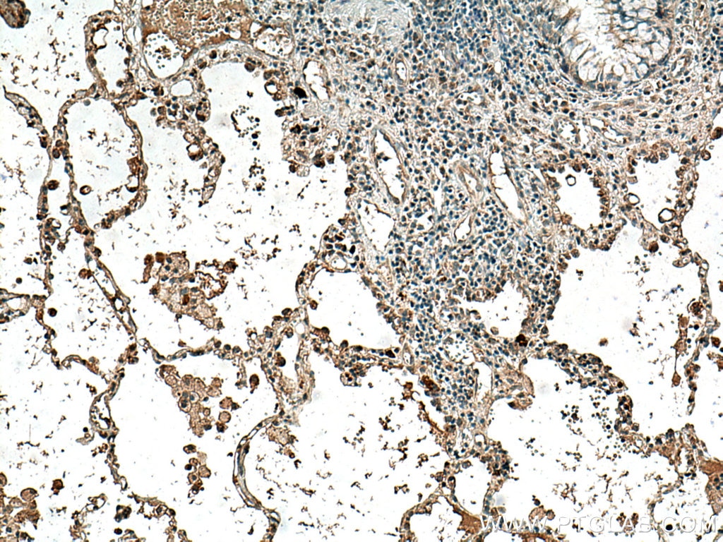 Immunohistochemistry (IHC) staining of human lung cancer tissue using VEGFA Polyclonal antibody (19003-1-AP)