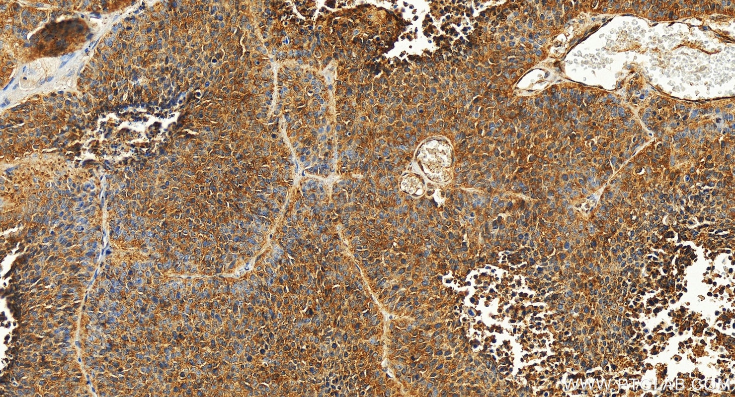 Immunohistochemistry (IHC) staining of human lung cancer tissue using VEGFA Polyclonal antibody (19003-1-AP)