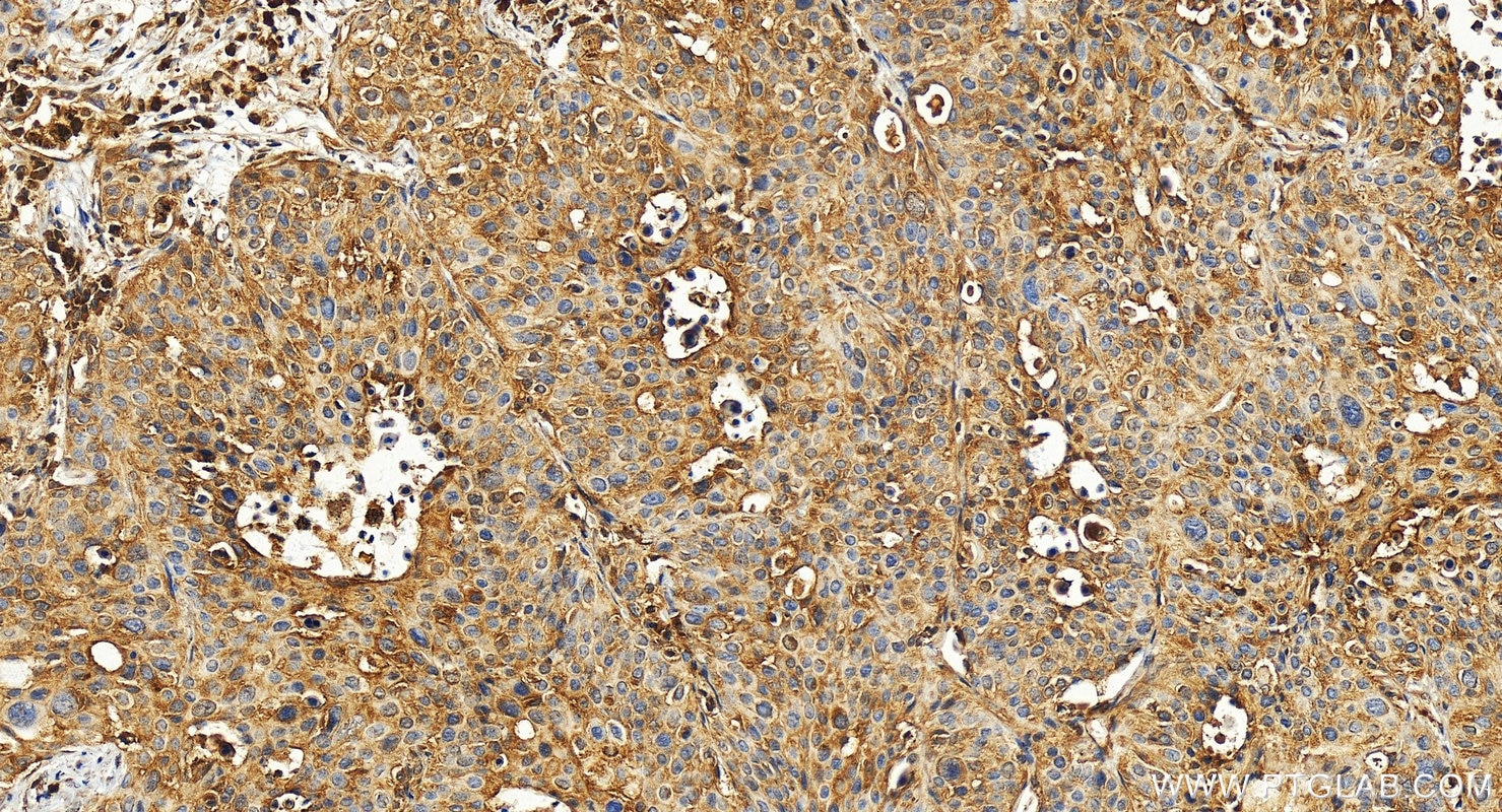 Immunohistochemistry (IHC) staining of human lung cancer tissue using VEGFA Polyclonal antibody (19003-1-AP)