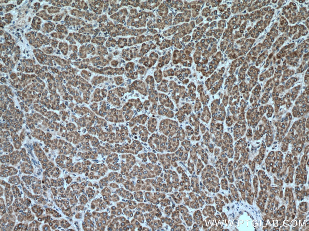 Immunohistochemistry (IHC) staining of human liver cancer tissue using VEGFA Polyclonal antibody (26381-1-AP)