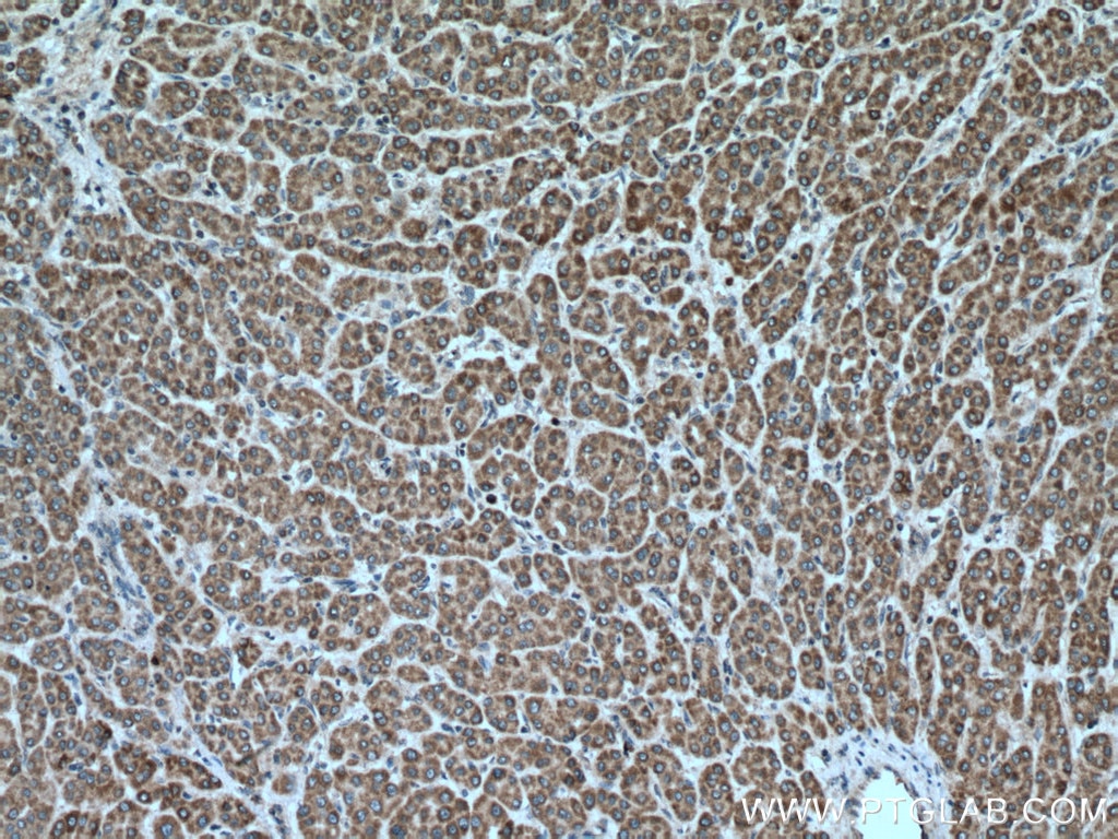 Immunohistochemistry (IHC) staining of human liver cancer tissue using VEGFA Polyclonal antibody (26381-1-AP)