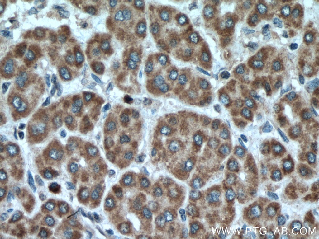 Immunohistochemistry (IHC) staining of human liver cancer tissue using VEGFA Polyclonal antibody (26381-1-AP)