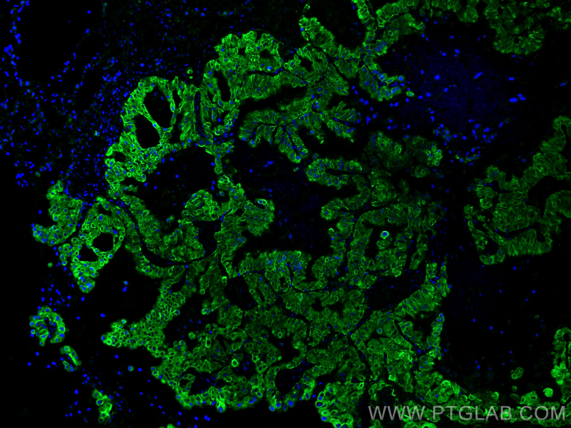 Immunofluorescence (IF) / fluorescent staining of human lung cancer tissue using VEGFA Monoclonal antibody (66828-1-Ig)