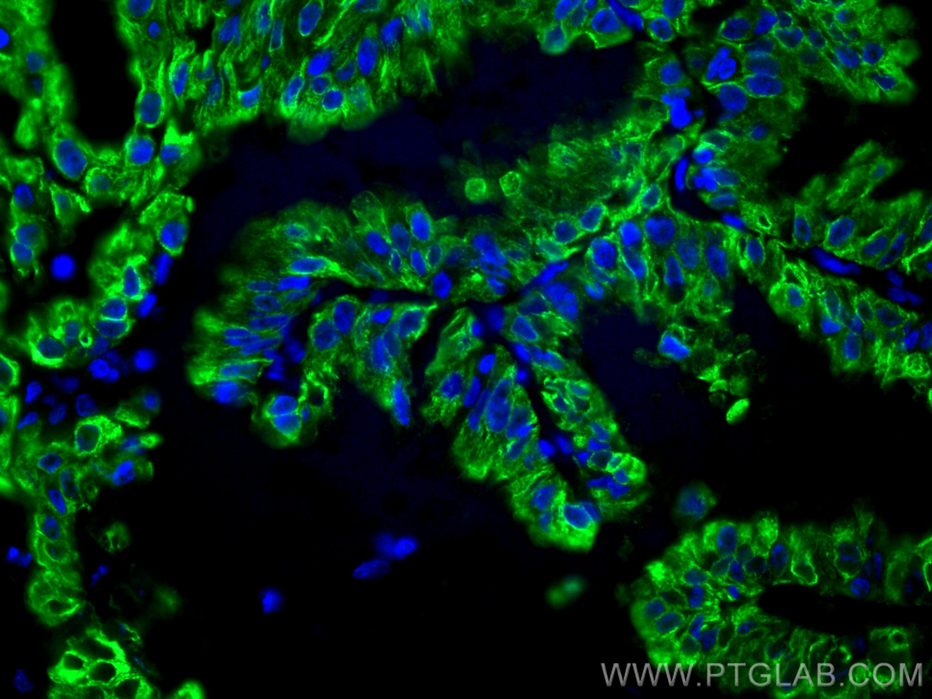 Immunofluorescence (IF) / fluorescent staining of human lung cancer tissue using VEGFA Monoclonal antibody (66828-1-Ig)