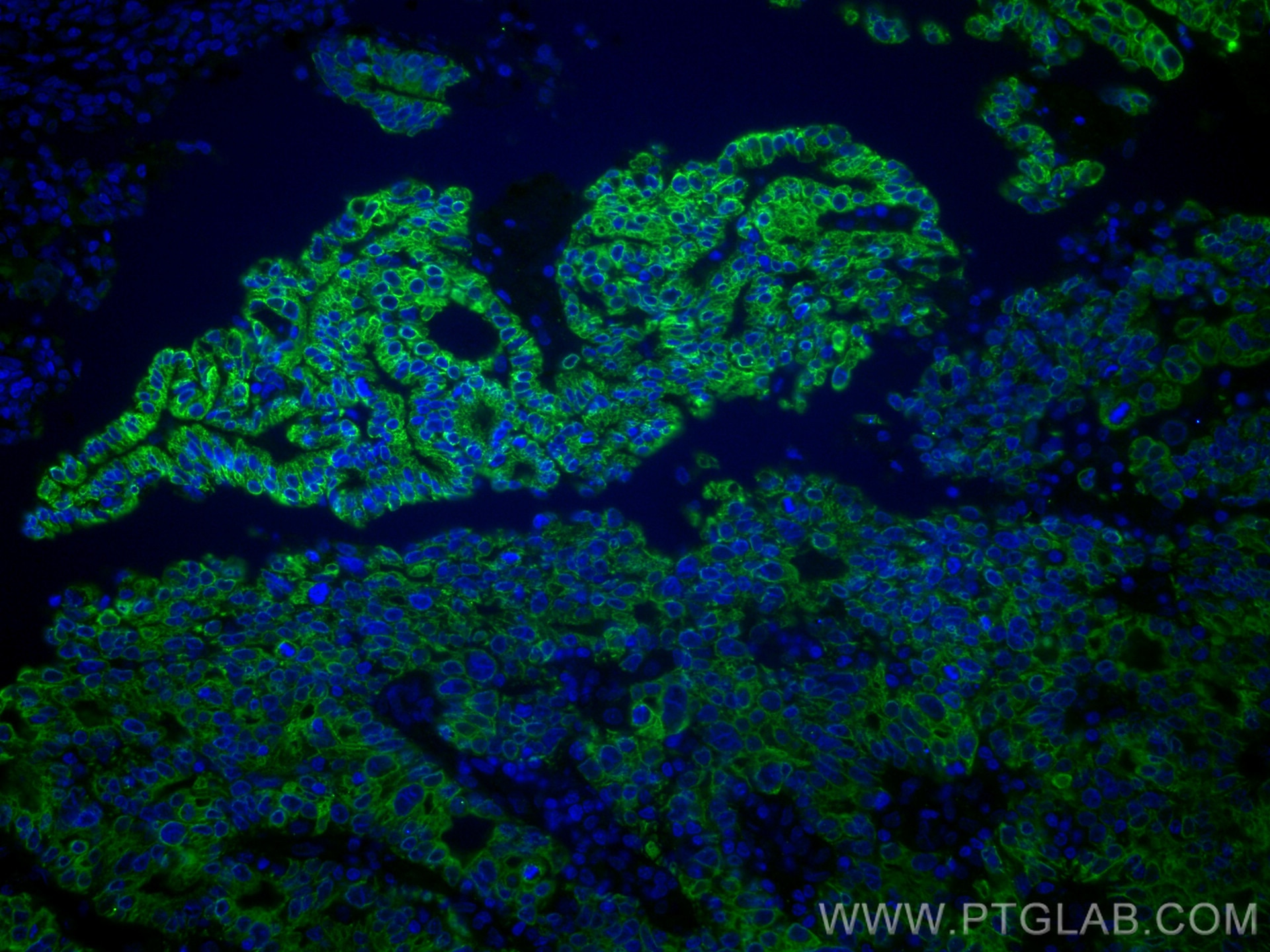 Immunofluorescence (IF) / fluorescent staining of human endometrial cancer tissue using VEGFA Monoclonal antibody (66828-1-Ig)