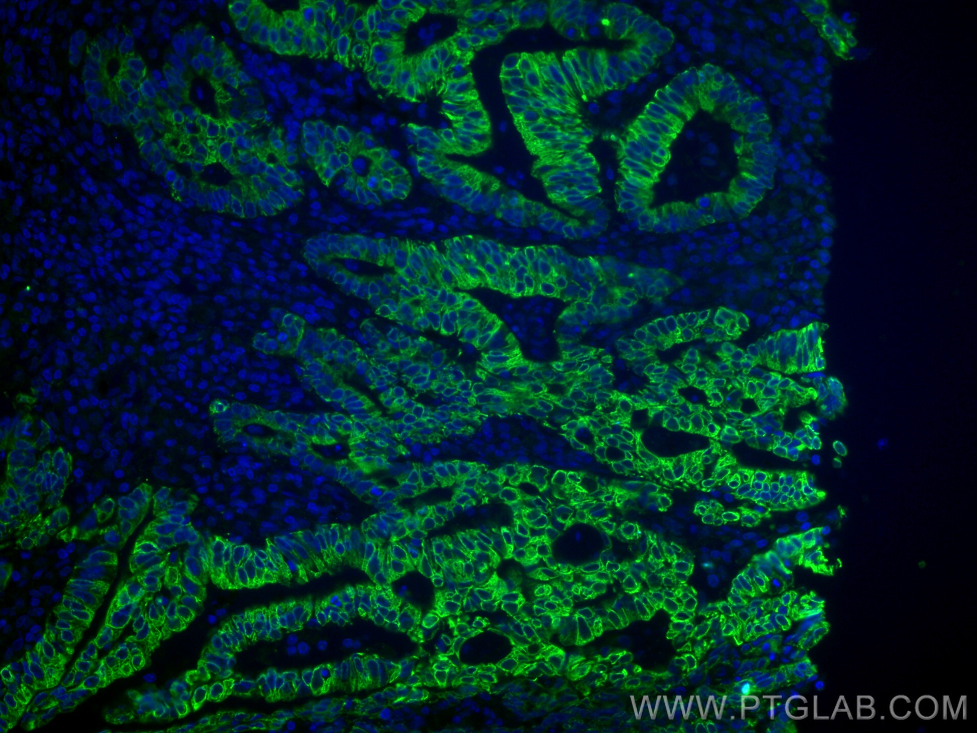 Immunofluorescence (IF) / fluorescent staining of human endometrial cancer tissue using VEGFA Monoclonal antibody (66828-1-Ig)