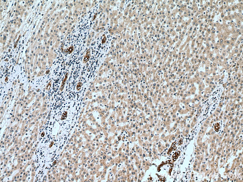 Immunohistochemistry (IHC) staining of human liver cancer tissue using VEGFA Monoclonal antibody (66828-1-Ig)