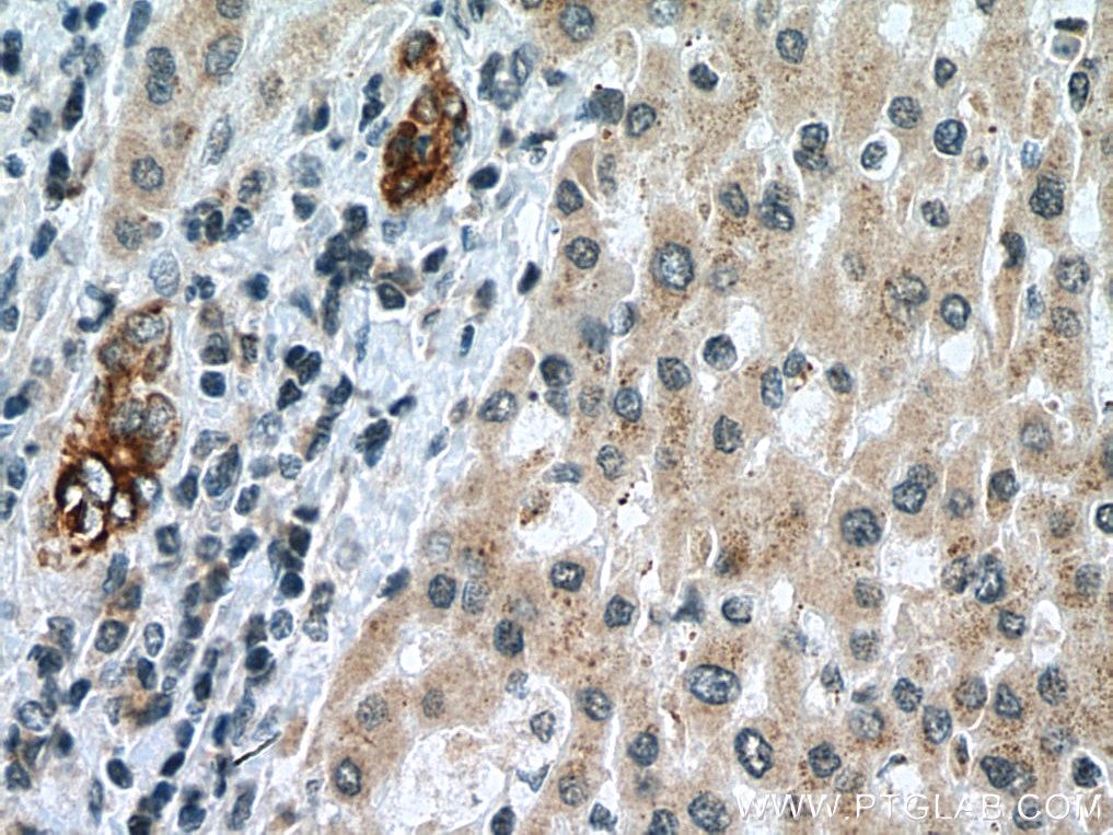 Immunohistochemistry (IHC) staining of human liver cancer tissue using VEGFA Monoclonal antibody (66828-1-Ig)