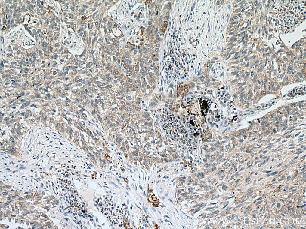 Immunohistochemistry (IHC) staining of human lung cancer tissue using VEGFA Monoclonal antibody (66828-1-Ig)