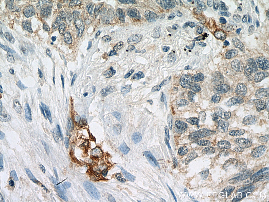 Immunohistochemistry (IHC) staining of human lung cancer tissue using VEGFA Monoclonal antibody (66828-1-Ig)