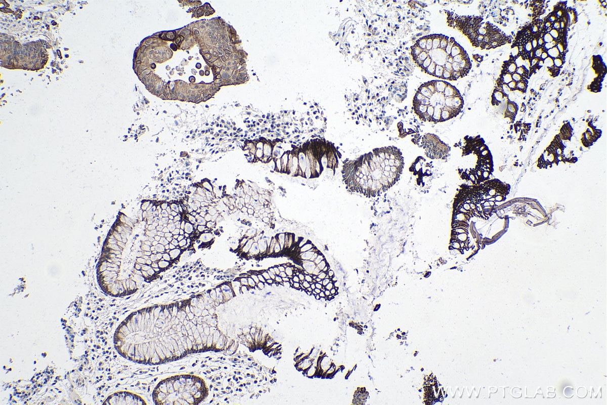Immunohistochemistry (IHC) staining of human colon cancer tissue using VEGFA Monoclonal antibody (66828-1-Ig)