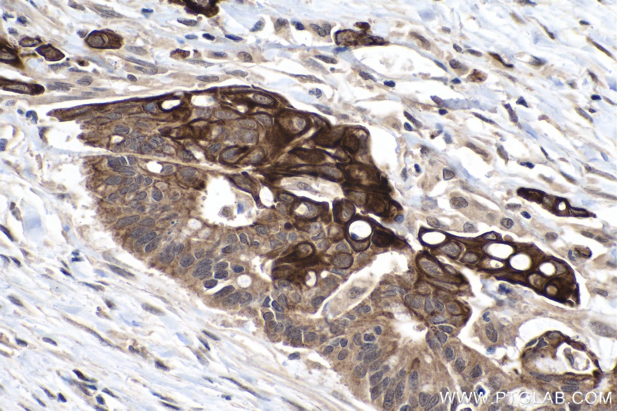 Immunohistochemistry (IHC) staining of human colon cancer tissue using VEGFA Monoclonal antibody (66828-1-Ig)