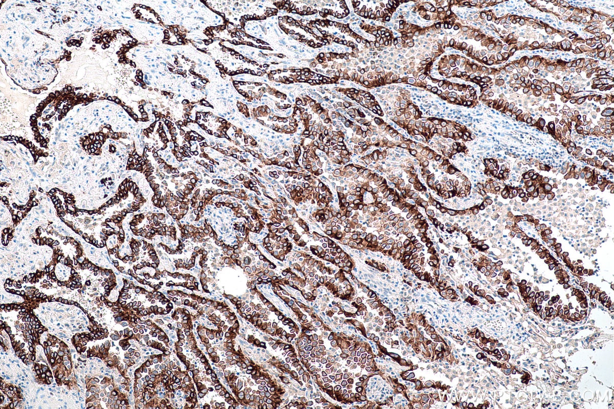 Immunohistochemistry (IHC) staining of human lung cancer tissue using VEGFA Monoclonal antibody (66828-1-Ig)