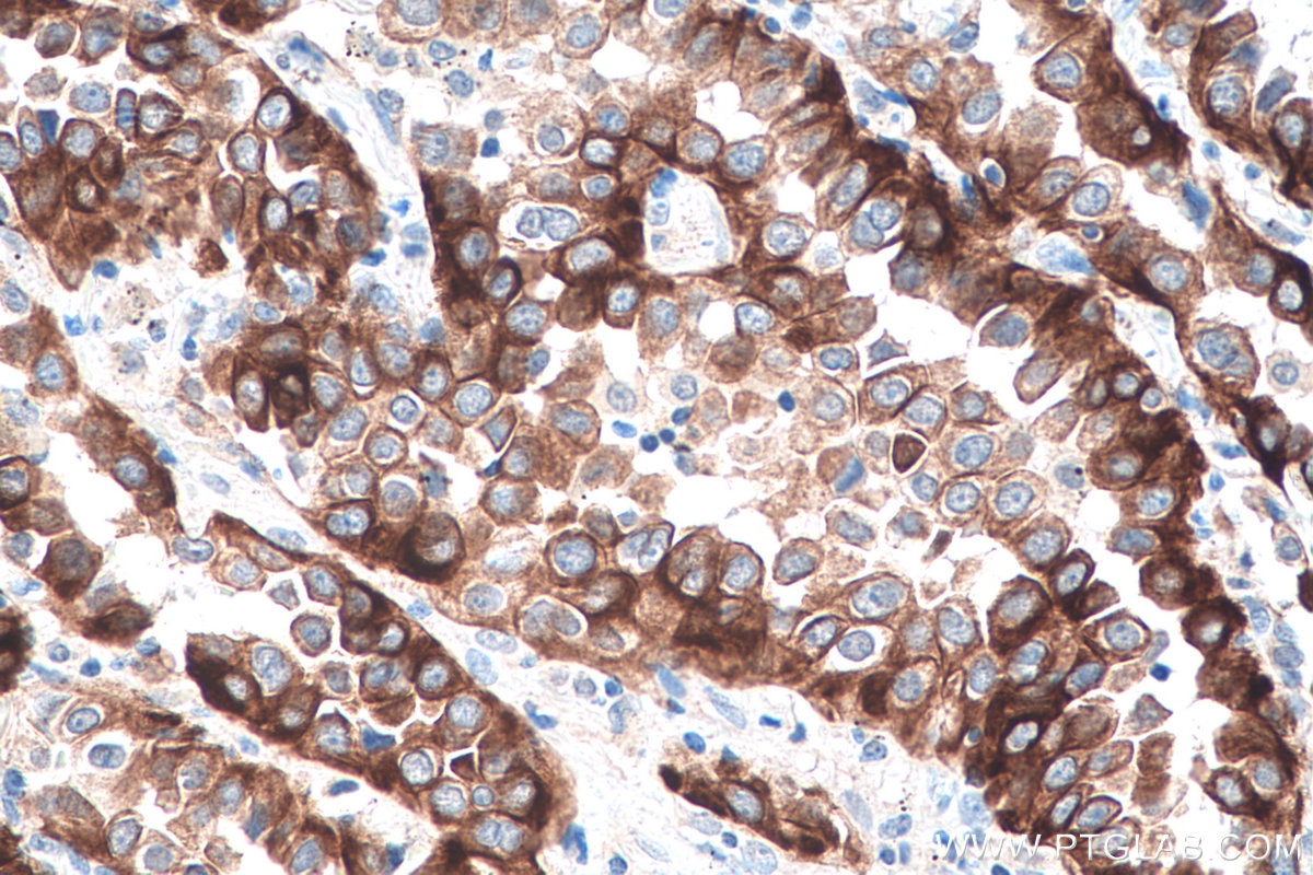 Immunohistochemistry (IHC) staining of human lung cancer tissue using VEGFA Monoclonal antibody (66828-1-Ig)