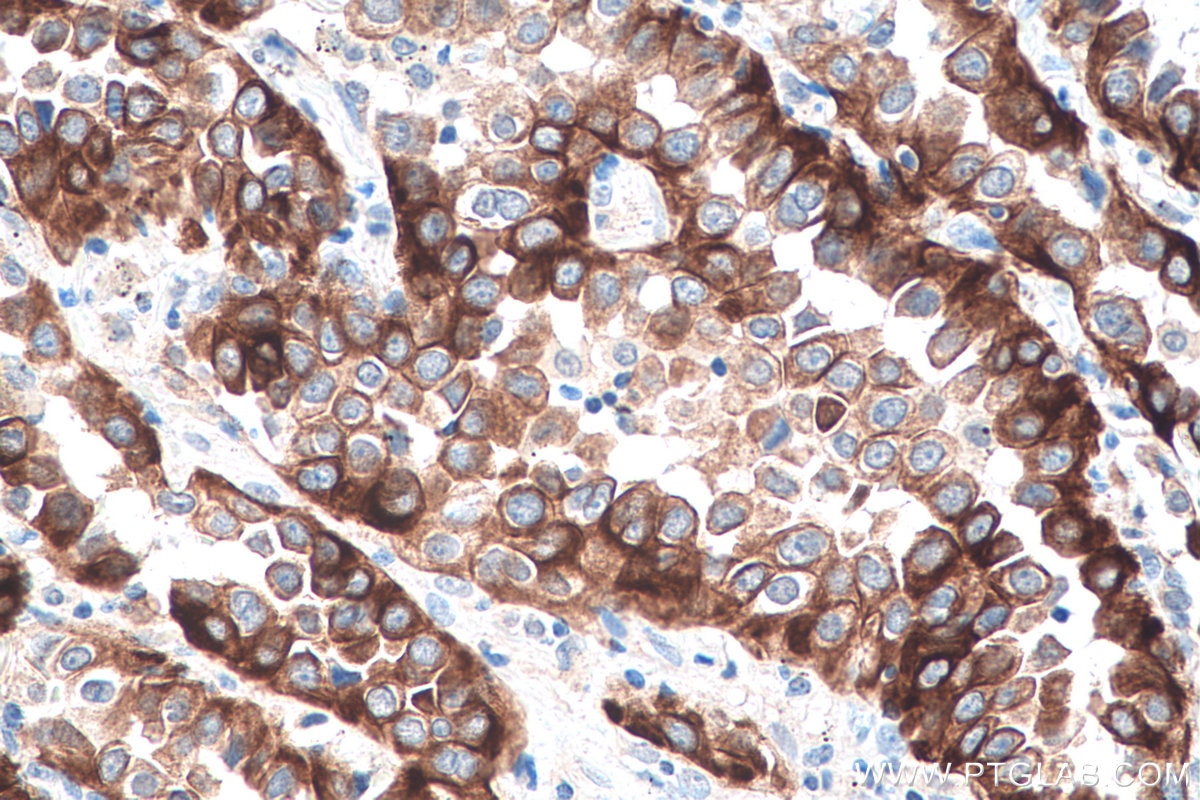 IHC staining of human lung cancer using 66828-1-Ig