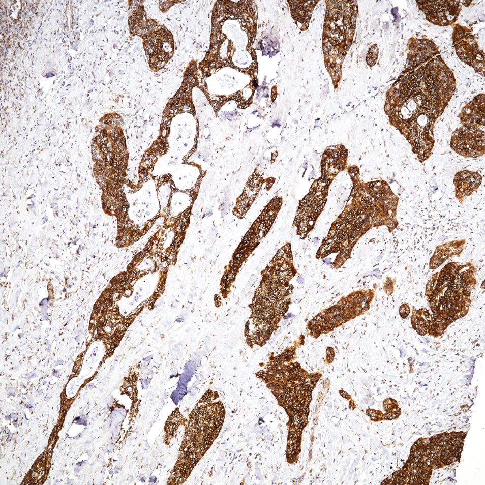 Immunohistochemistry (IHC) staining of human Lung Cancer tissue using VEGFA Monoclonal antibody (66828-1-Ig)