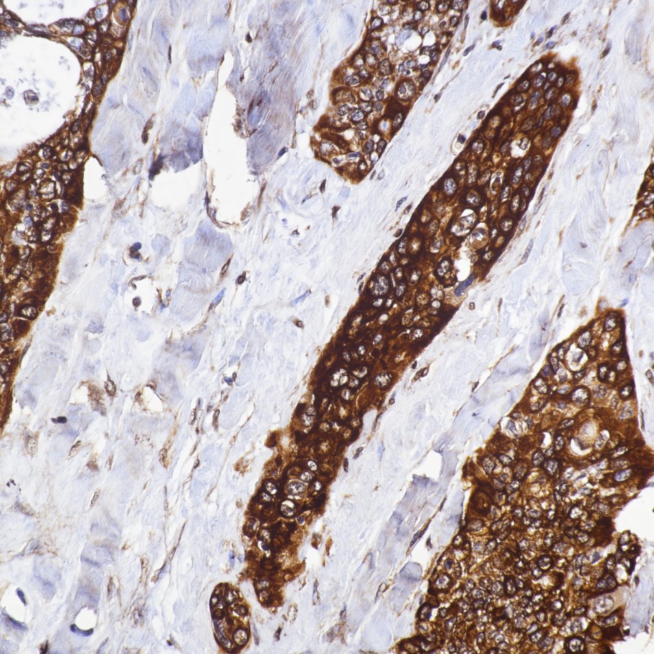 Immunohistochemistry (IHC) staining of human lung cancer tissue using VEGFA Monoclonal antibody (66828-1-Ig)