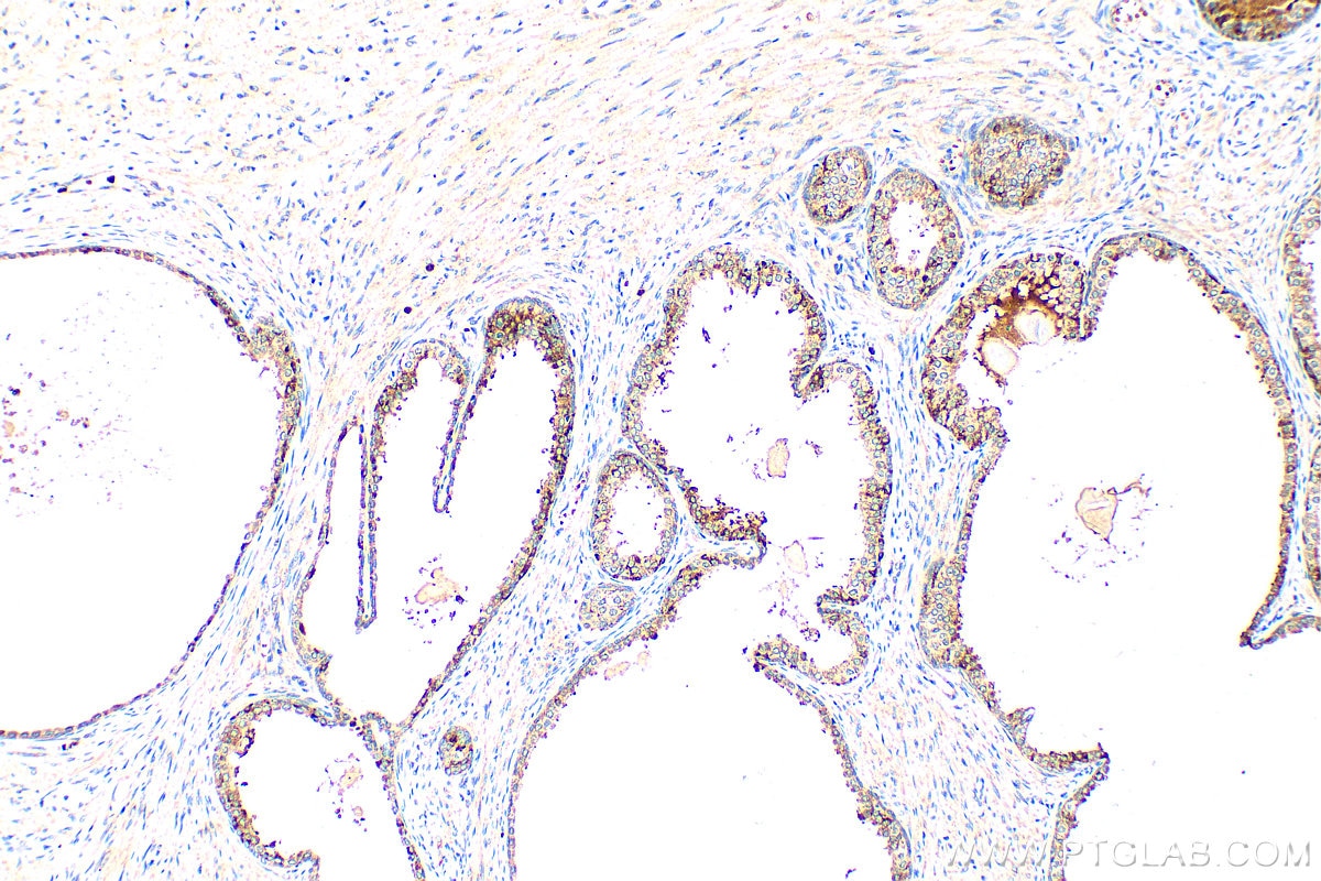 Immunohistochemistry (IHC) staining of human prostate cancer tissue using VEGFC Polyclonal antibody (22601-1-AP)