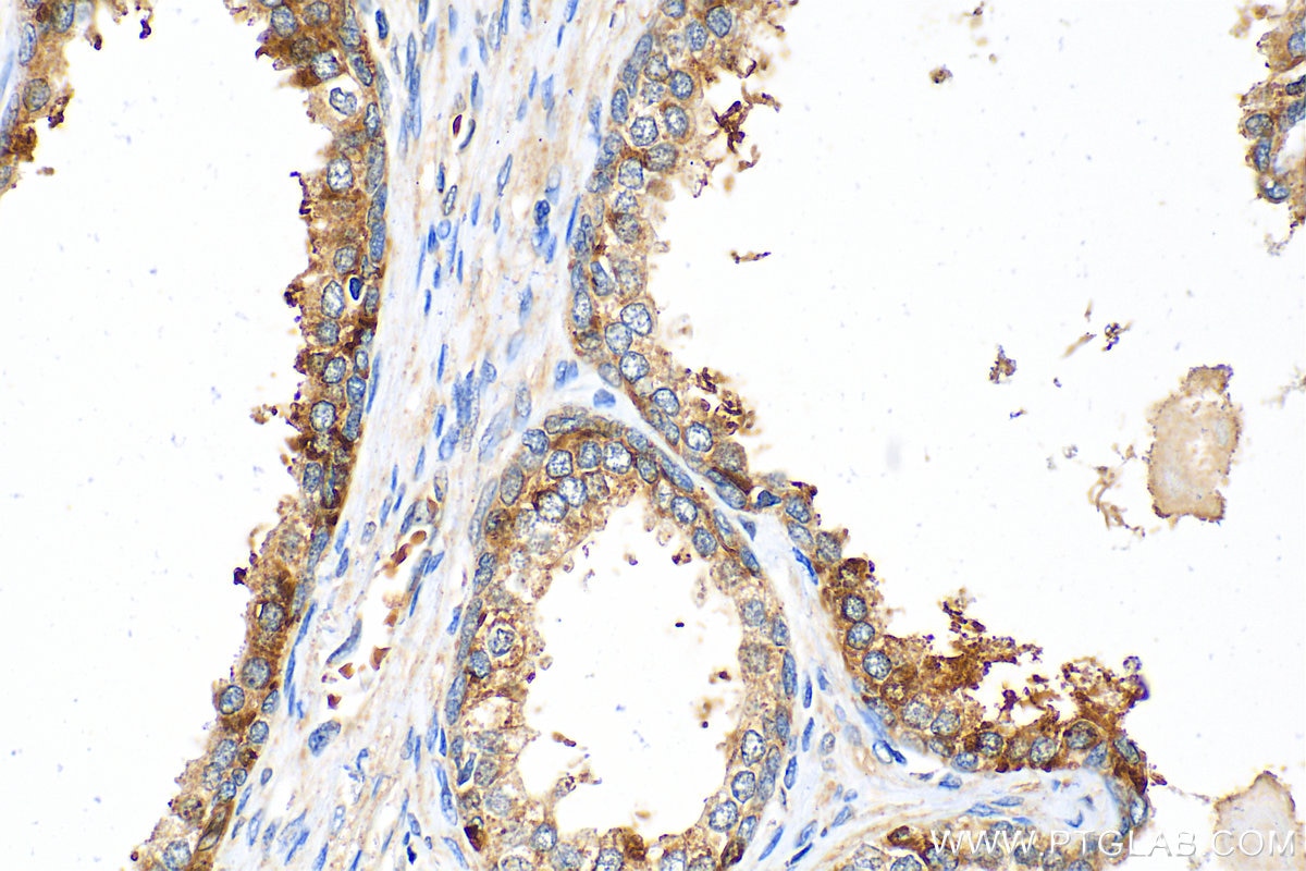 Immunohistochemistry (IHC) staining of human prostate cancer tissue using VEGFC Polyclonal antibody (22601-1-AP)