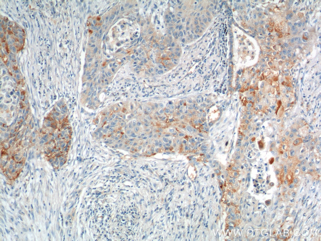 Immunohistochemistry (IHC) staining of human lung cancer tissue using VEGFC Polyclonal antibody (22601-1-AP)