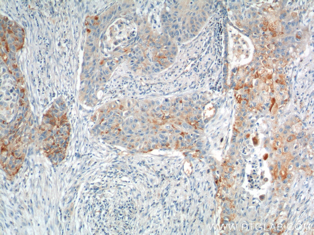Immunohistochemistry (IHC) staining of human lung cancer tissue using VEGFC Polyclonal antibody (22601-1-AP)