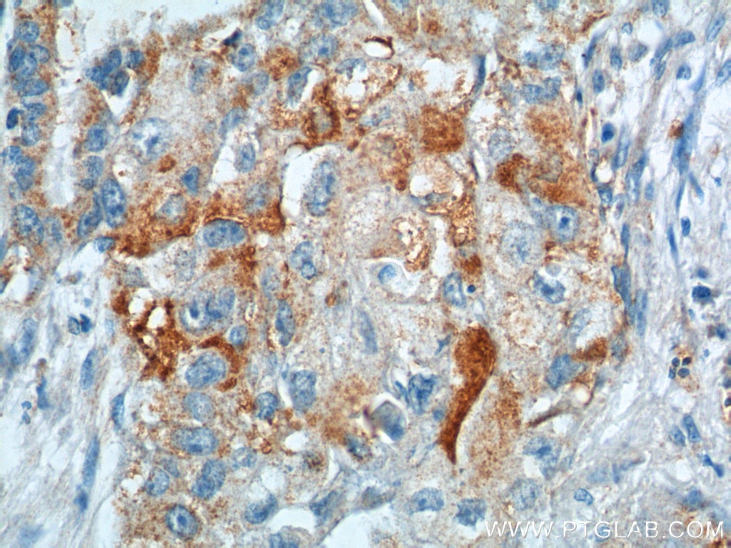 Immunohistochemistry (IHC) staining of human lung cancer tissue using VEGFC Polyclonal antibody (22601-1-AP)