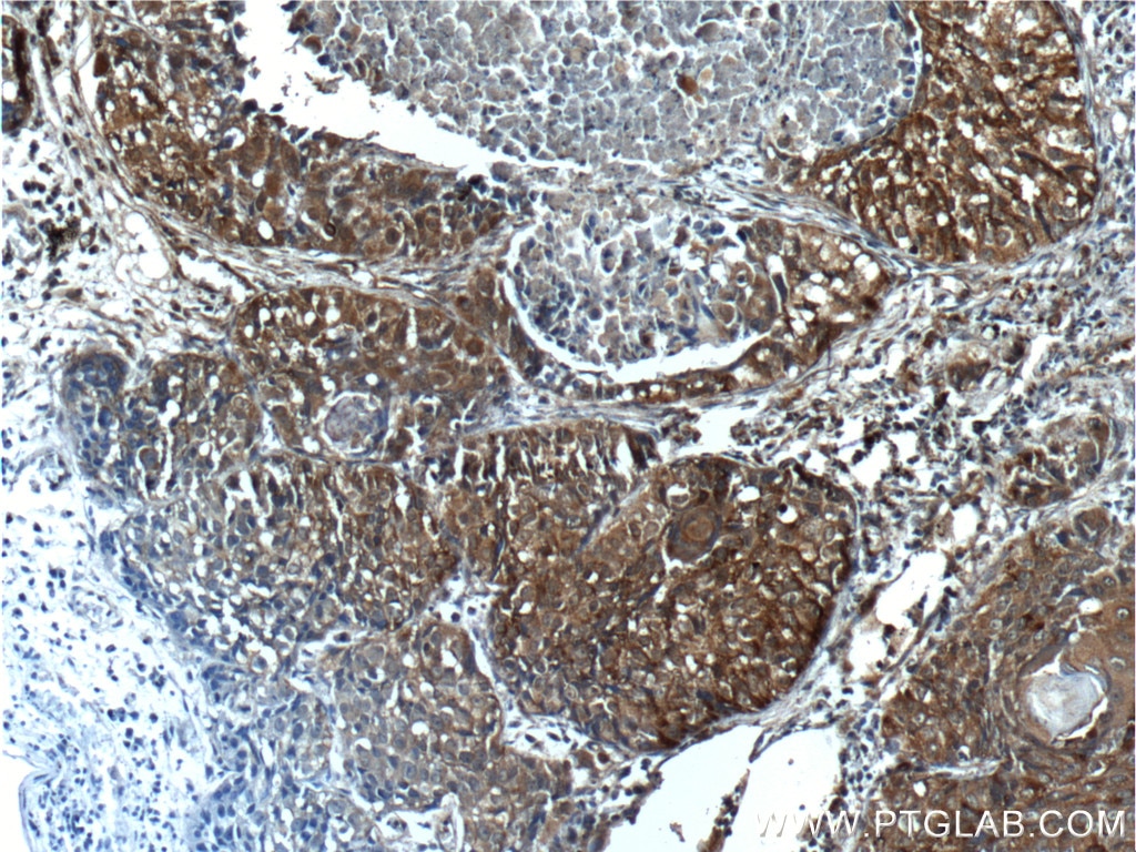 Immunohistochemistry (IHC) staining of human lung cancer tissue using VEGFC Polyclonal antibody (22601-1-AP)