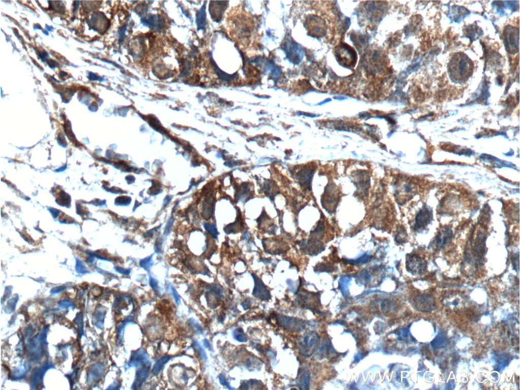 IHC staining of human lung cancer using 22601-1-AP