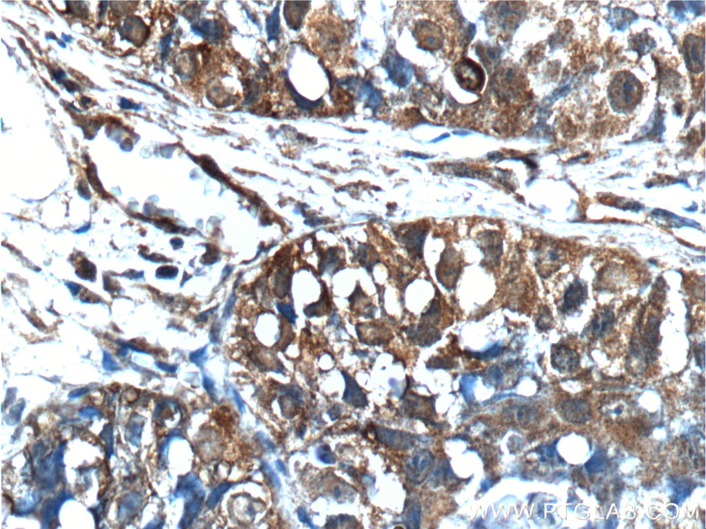 Immunohistochemistry (IHC) staining of human lung cancer tissue using VEGFC Polyclonal antibody (22601-1-AP)