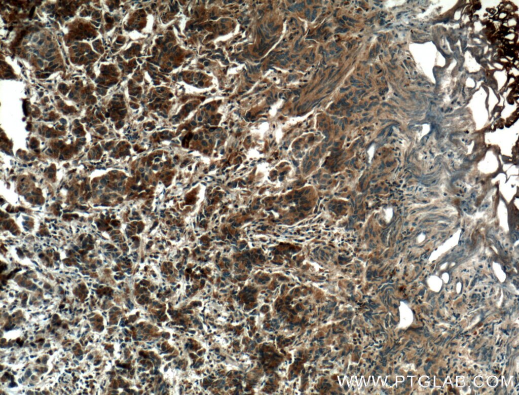 IHC staining of human prostate cancer using 22601-1-AP
