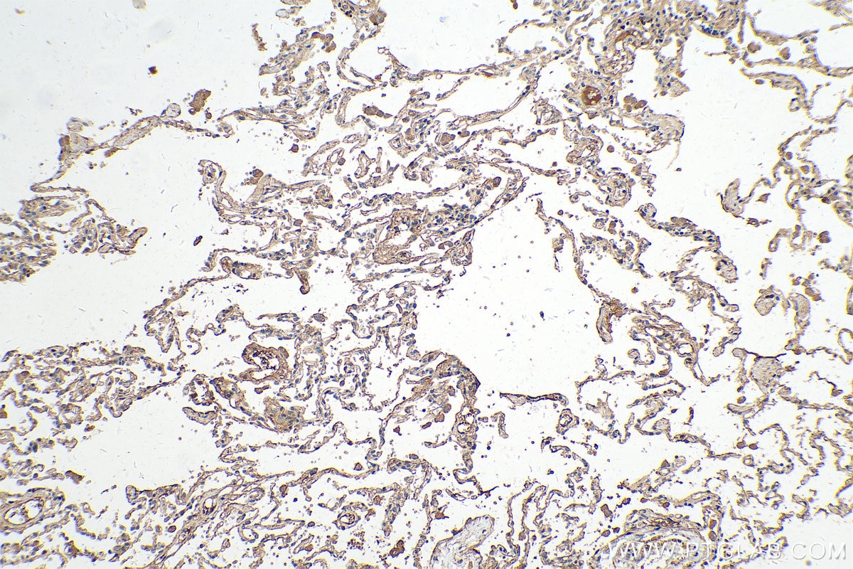 Immunohistochemistry (IHC) staining of human lung cancer tissue using VEGFD Polyclonal antibody (26915-1-AP)