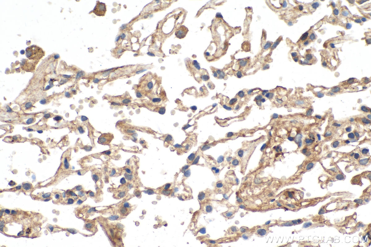 IHC staining of human lung cancer using 26915-1-AP