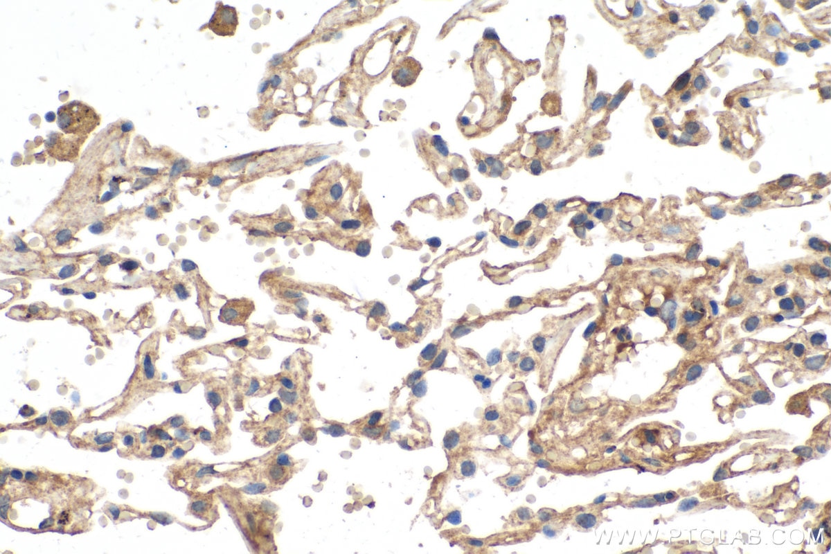 Immunohistochemistry (IHC) staining of human lung cancer tissue using VEGFD Polyclonal antibody (26915-1-AP)