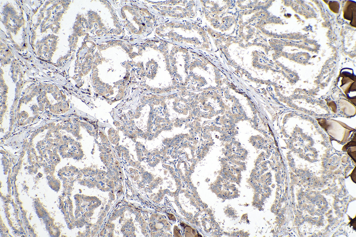Immunohistochemistry (IHC) staining of human thyroid cancer tissue using VEGFD Polyclonal antibody (26915-1-AP)