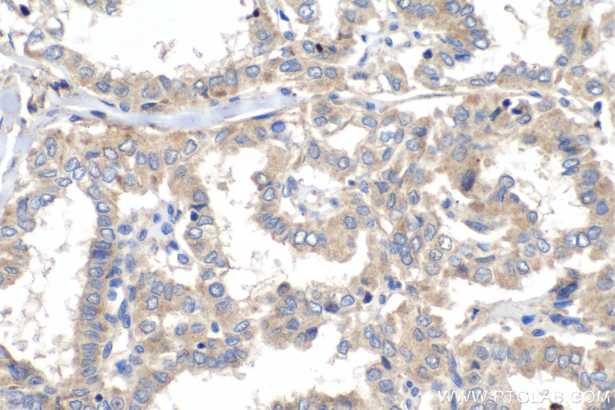 Immunohistochemistry (IHC) staining of human thyroid cancer tissue using VEGFD Polyclonal antibody (26915-1-AP)
