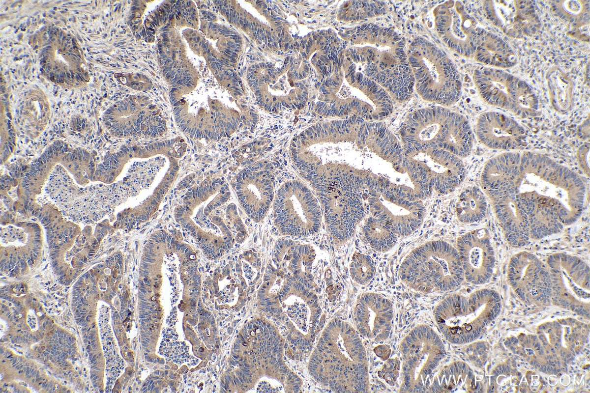 Immunohistochemistry (IHC) staining of human colon cancer tissue using VEGFD Polyclonal antibody (26915-1-AP)