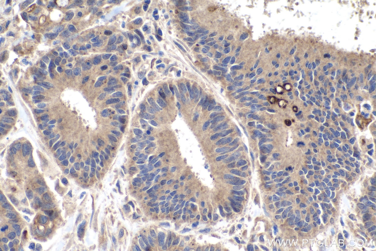 Immunohistochemistry (IHC) staining of human colon cancer tissue using VEGFD Polyclonal antibody (26915-1-AP)