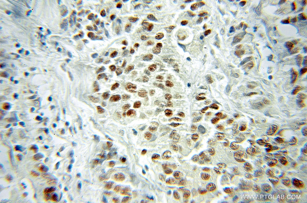 Immunohistochemistry (IHC) staining of human prostate cancer tissue using VGLL1 Polyclonal antibody (10124-2-AP)
