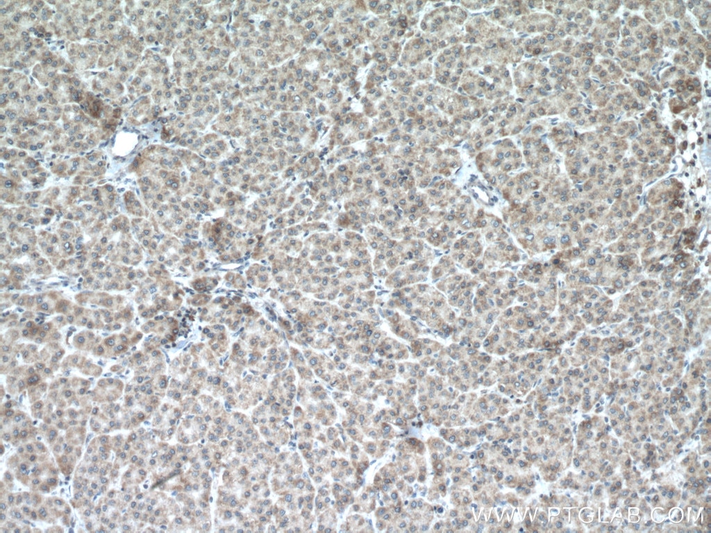 Immunohistochemistry (IHC) staining of human liver cancer tissue using VHL Polyclonal antibody (16538-1-AP)